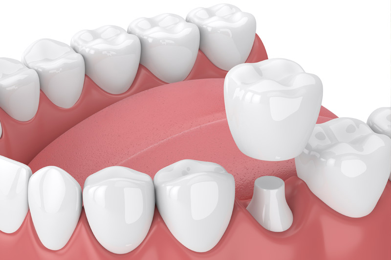 Dental Crowns in Milwaukee