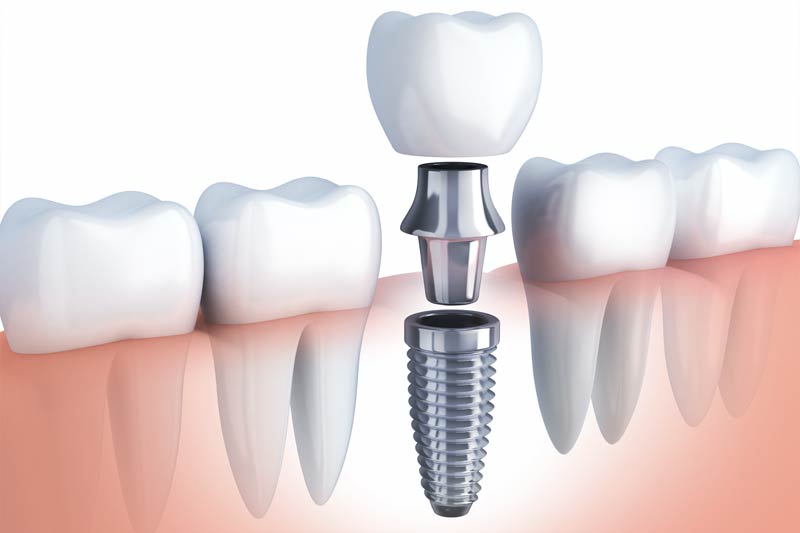 Implants Dentist in Milwaukee