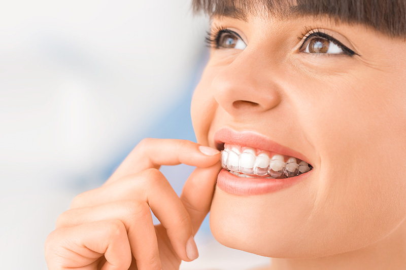 Clear Aligner Treatment in Milwaukee