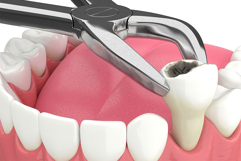 Tooth Extraction in Milwaukee